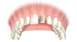 Zahnkrone-Behandlungsablauf-1