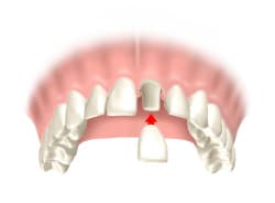 Zahnkrone-Behandlungsablauf-2