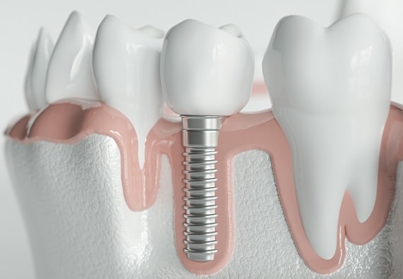 Zähne sanieren: Zahnimplantate