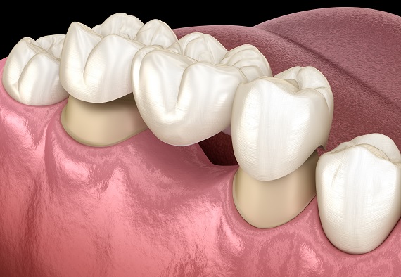 Zahnsanierung durch Zahnbrücken und Kronen