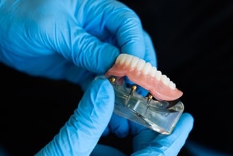 zahnersatz-schweiz-kosten